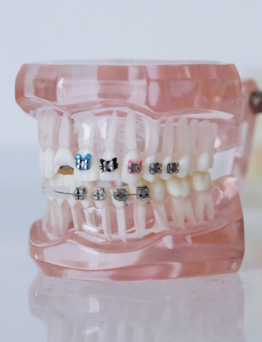 Model set of teeth with braces